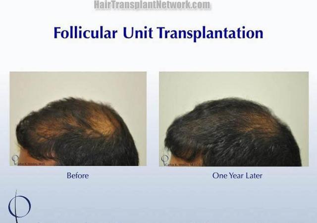 Hair transplantation surgery before and after photos