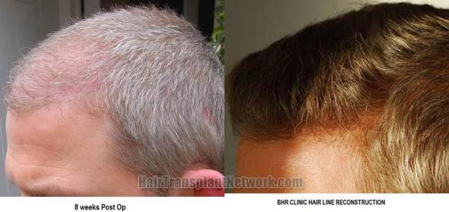 Hair transplantation surgery before and after pictures