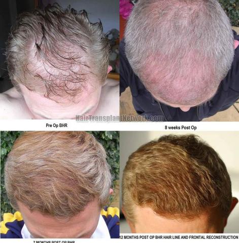 Hair transplantation surgery before and after photos