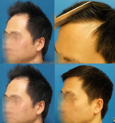 Hair transplantation surgery before and after pictures