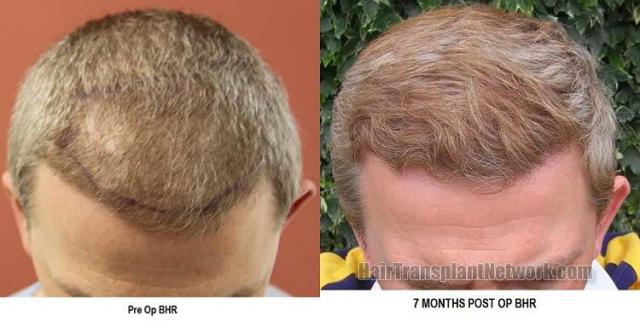 Hair restoration procedure before and after pictures