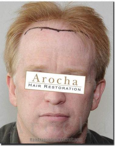 Hair restoration procedure results