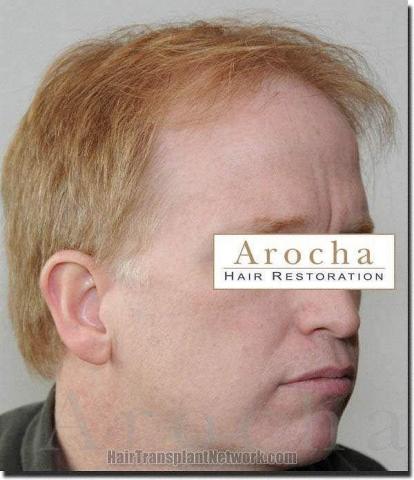 Hair restoration procedure results