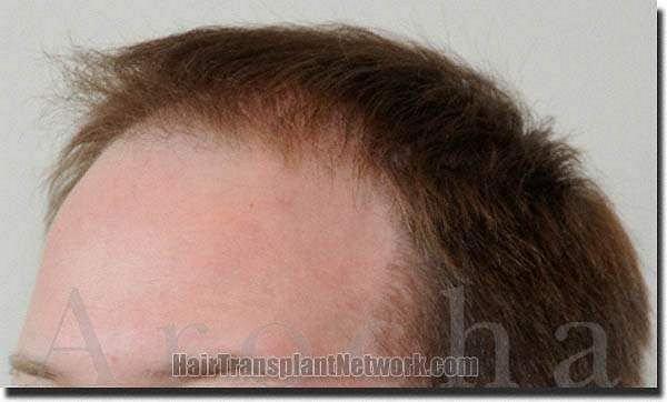 Hair restoration procedure results