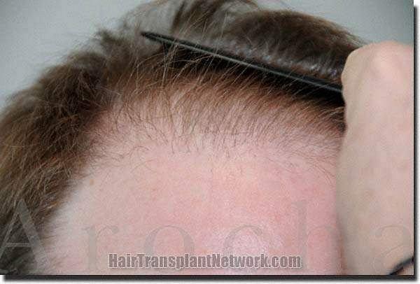 Hair restoration procedure results