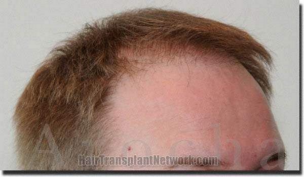 Hair restoration procedure results