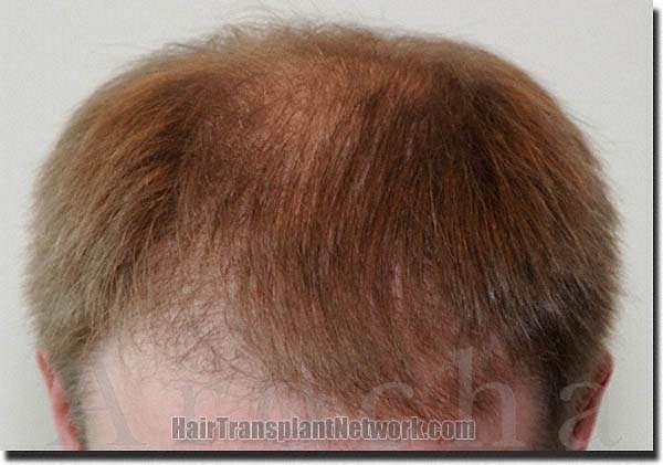 Hair restoration procedure results