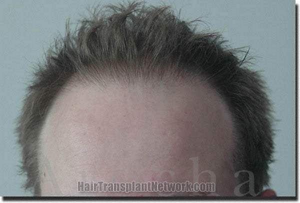 Hair restoration procedure results