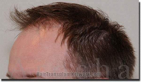 Hair restoration procedure results