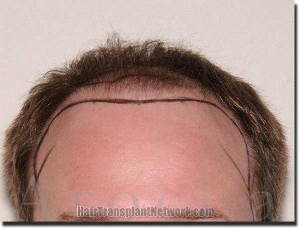 Hair restoration procedure results