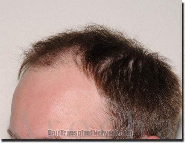 Hair restoration procedure results