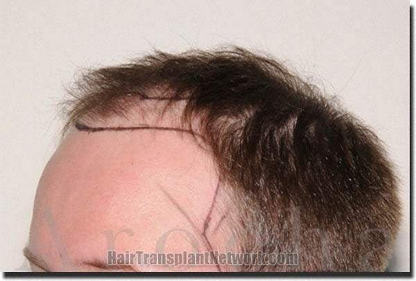 Hair restoration procedure results