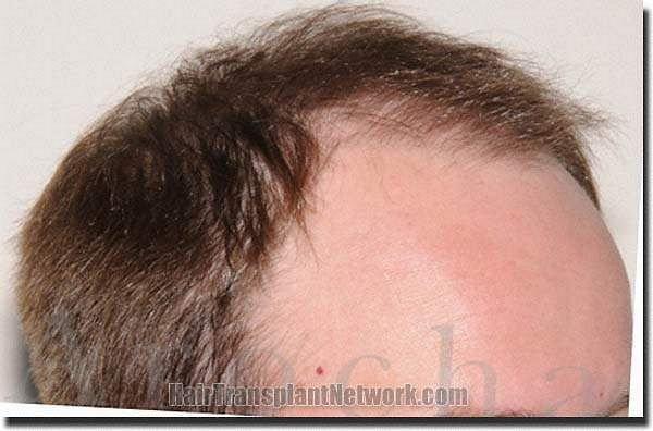 Hair restoration procedure results