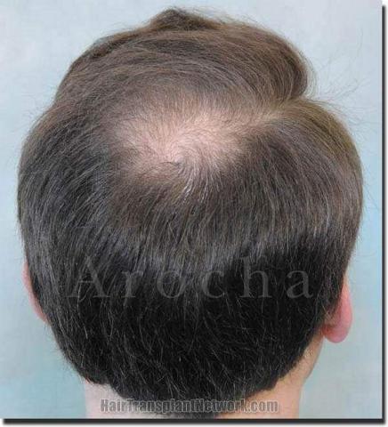 Hair restoration procedure results