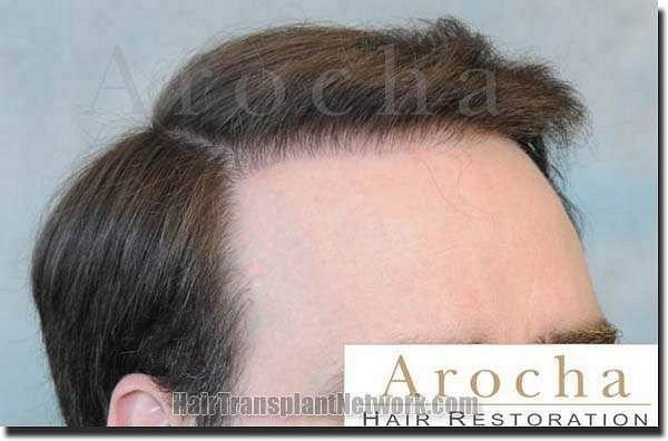 Hair restoration procedure results