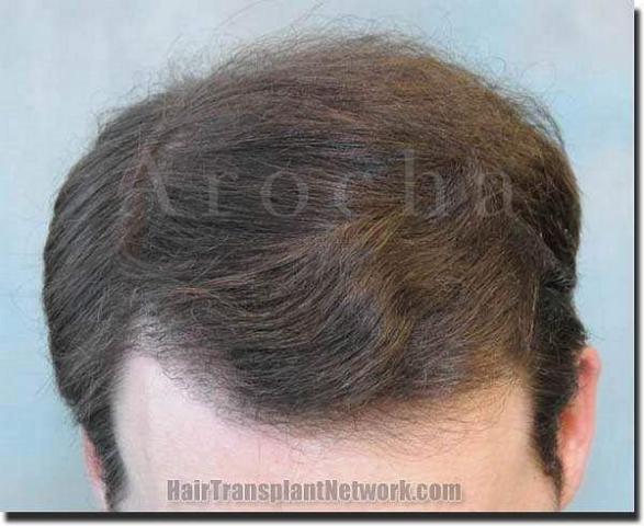 Hair restoration procedure results