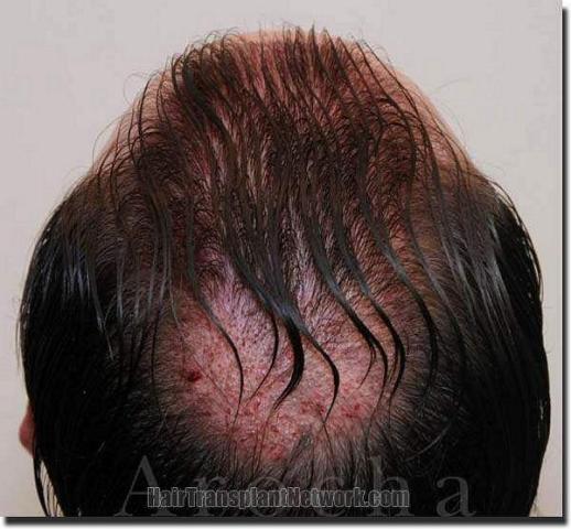 Hair restoration procedure results