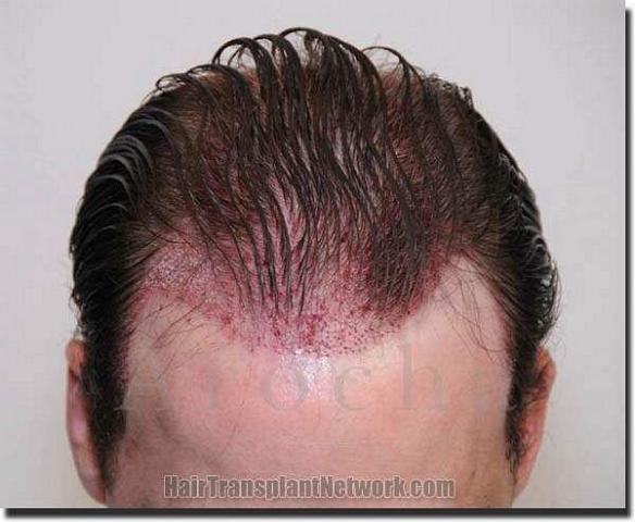 Hair restoration procedure results