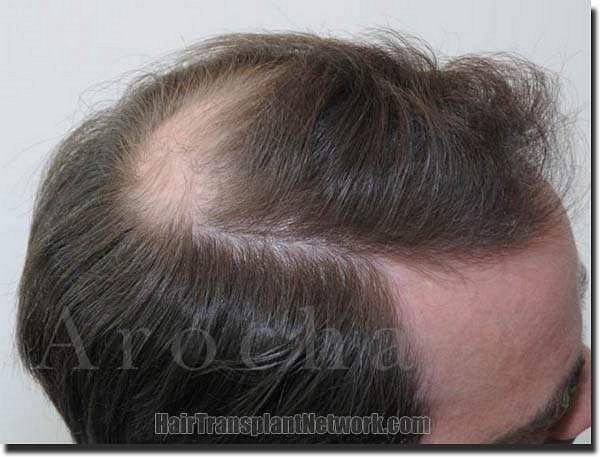 Hair restoration procedure results