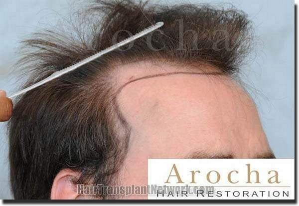 Hair restoration procedure results