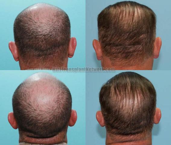 Hair transplantation procedure before and after photo results
