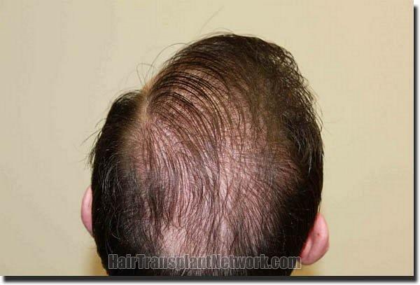 Hair restoration procedure results