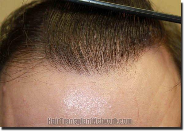 Hair restoration procedure results