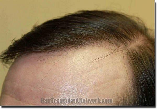 Hair restoration procedure results