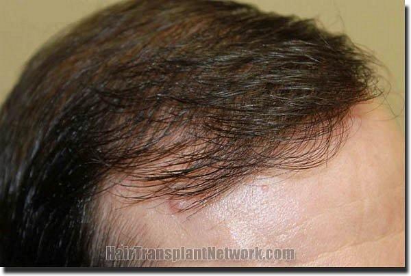 Hair restoration procedure results