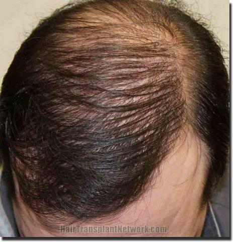 Hair restoration procedure results