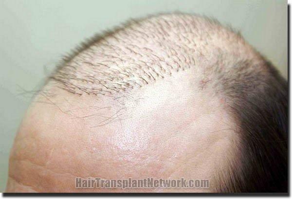 Hair restoration procedure results