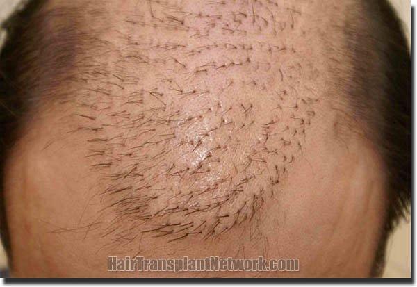 Hair restoration procedure results