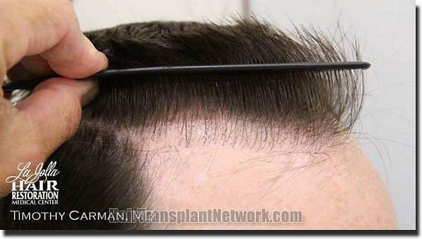 Hair restoration procedure results