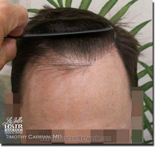 Hair restoration procedure results