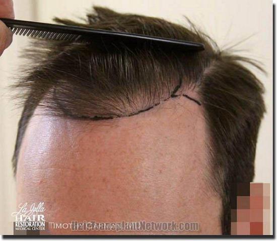 Hair restoration procedure results