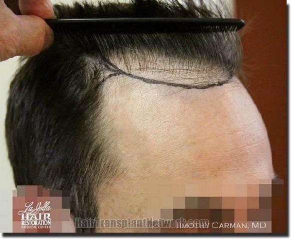 Hair restoration procedure results