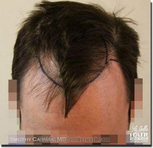 Hair restoration procedure results