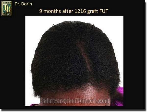 Hair restoration procedure results