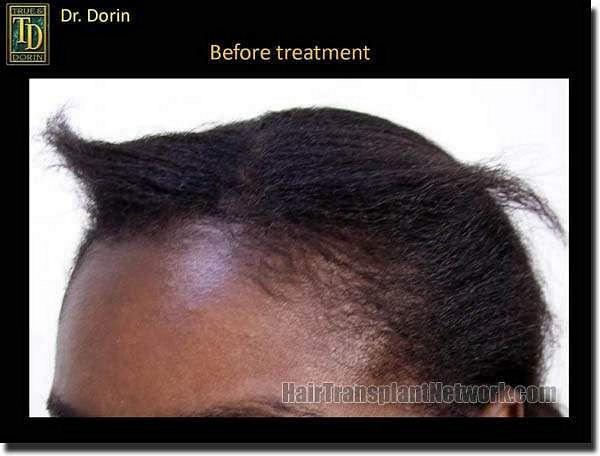 Hair restoration procedure results