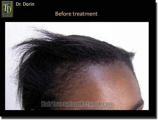 Hair restoration procedure results