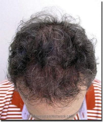 Hair restoration procedure results