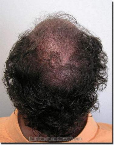 Hair restoration procedure results