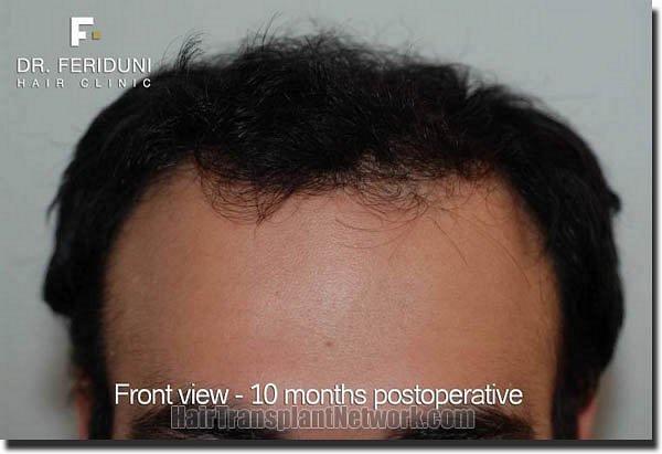 Hair restoration procedure results