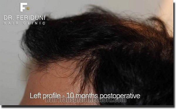 Hair restoration procedure results