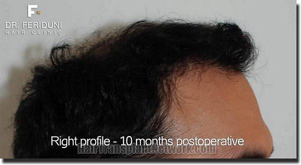 Hair restoration procedure results