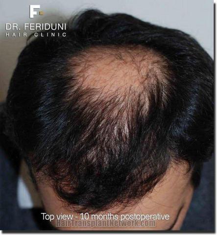 Hair restoration procedure results