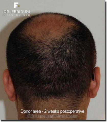 Hair restoration procedure results