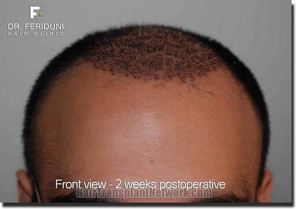 Hair restoration procedure results