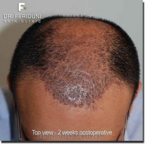 Hair restoration procedure results