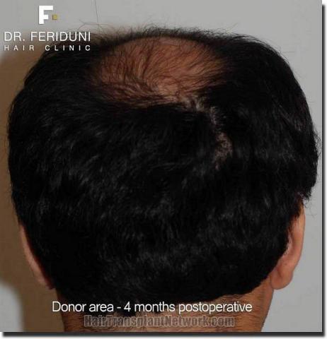 Hair restoration procedure results